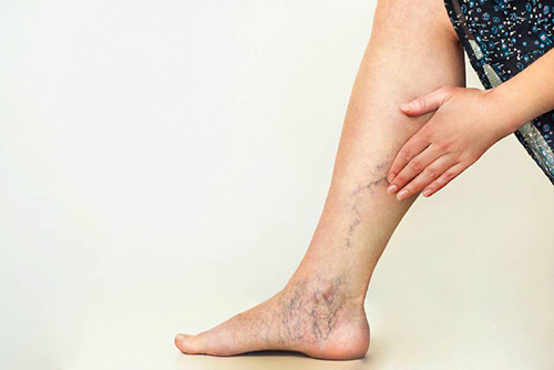 Here are the ten best ways to prevent varicose veins