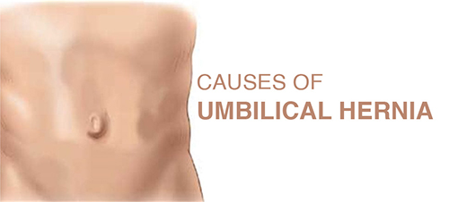 causes of umbilical hernia