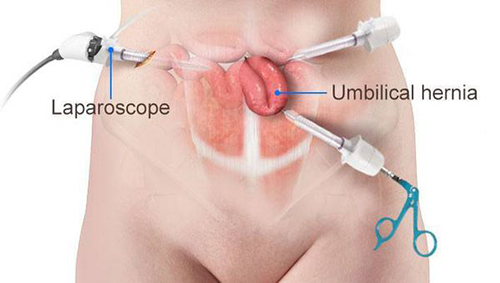 laparoscopic surgery for umbilical hernia