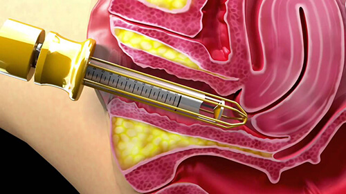 pictorial representation painless vaginal tightening procedure