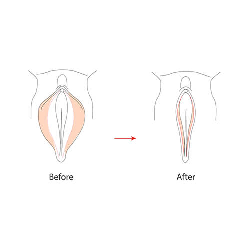 vaginoplasty before and after pictorial representation