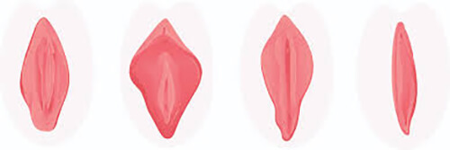 describing vaginoplasty in 4 different stages