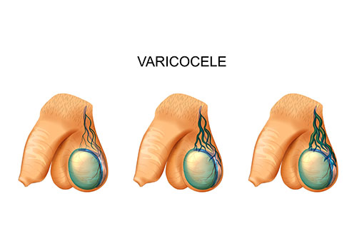 diagnosis of varicocele