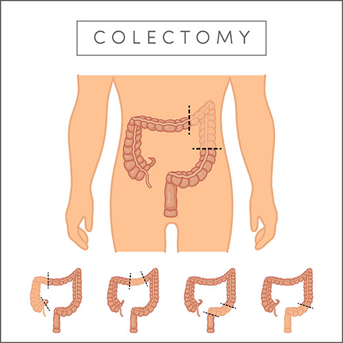 Colectomy