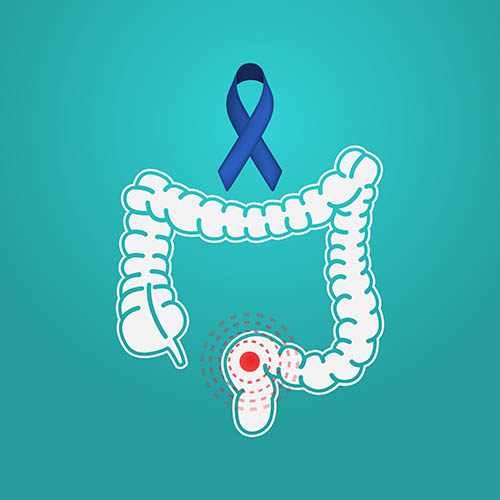Colon cancer