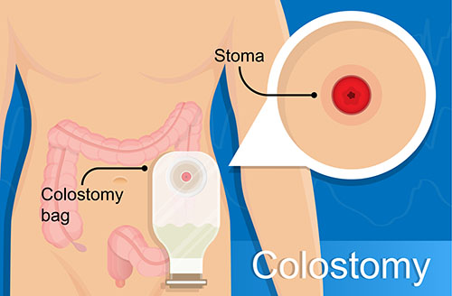 Colostomy