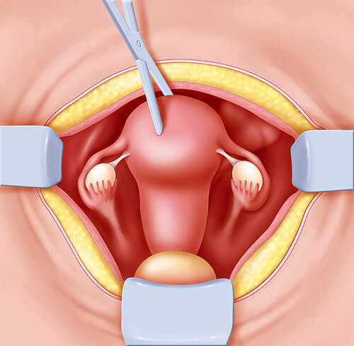 know about abdominal hysterectomy