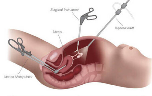 know about laparoscopic hysterectomy surgery