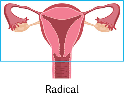 radical hysterectomy know about