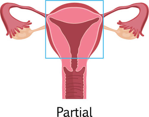 know about partial hysterectomy