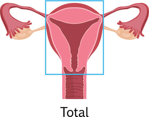 total hysterectomy