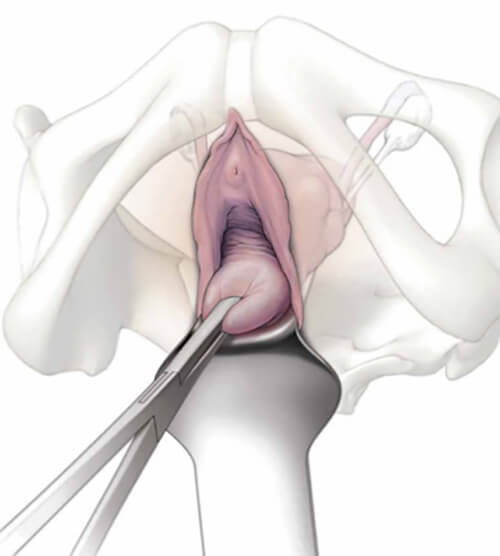 know about vaginal hysterectomy