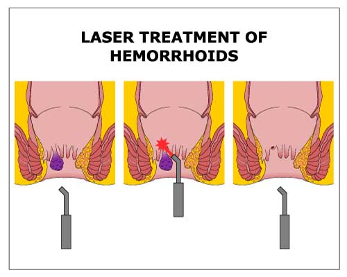 piles laser treatment