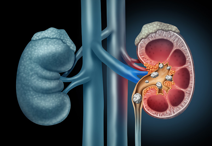 depiction of stones in kidney 