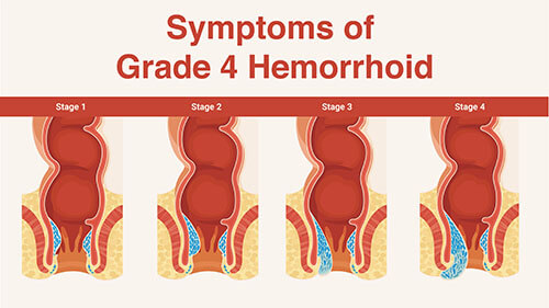 What is Grade 4 Hemorrhoid?