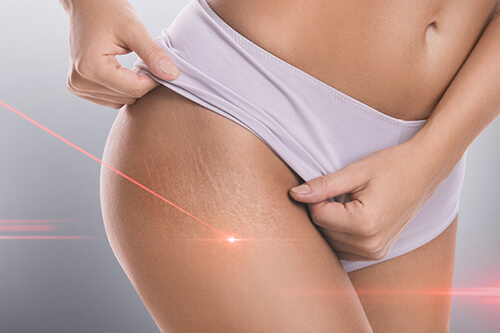 laser treatment on stretch marks on thighs of a female