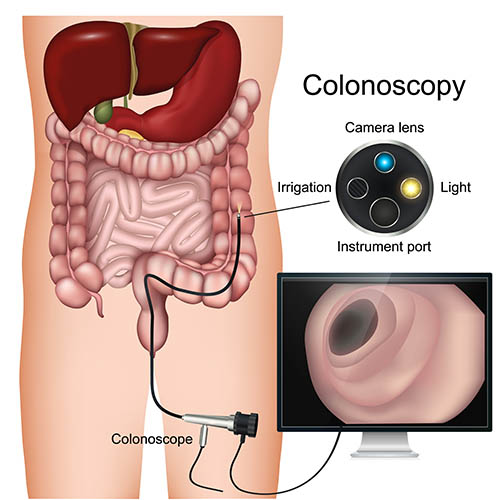 Colonoscopy Process