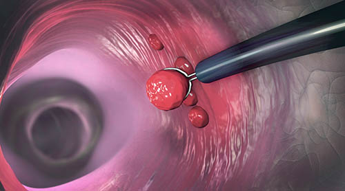 Removal of polyps