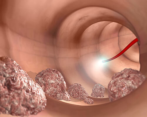 pictorial representation of anal cancer
