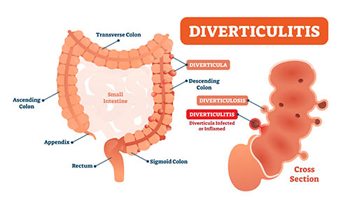 Diverticulitis
