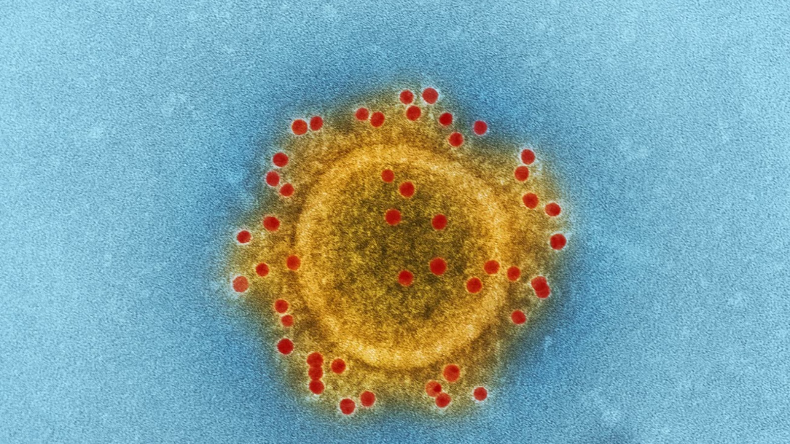 Measles claims third UK life, 883 cases confirmed since January 1