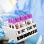 Donor cord blood composition may influence CAR NK cell therapy outcomes