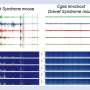 Inflammation may drive Dravet syndrome, offering a potential new treatment target