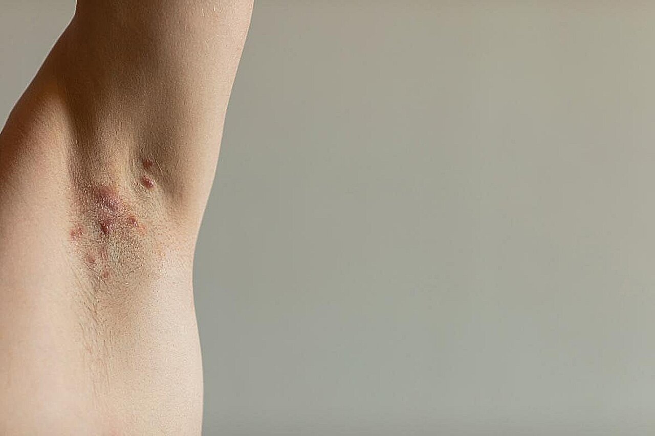 Povorcitinib beneficial for moderate-to-severe hidradenitis suppurativa