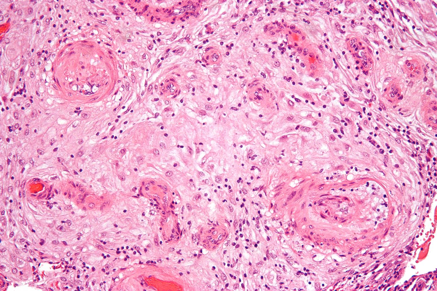 Preeclampsia rates in minority communities shed light on the social roots of maternal health disparities