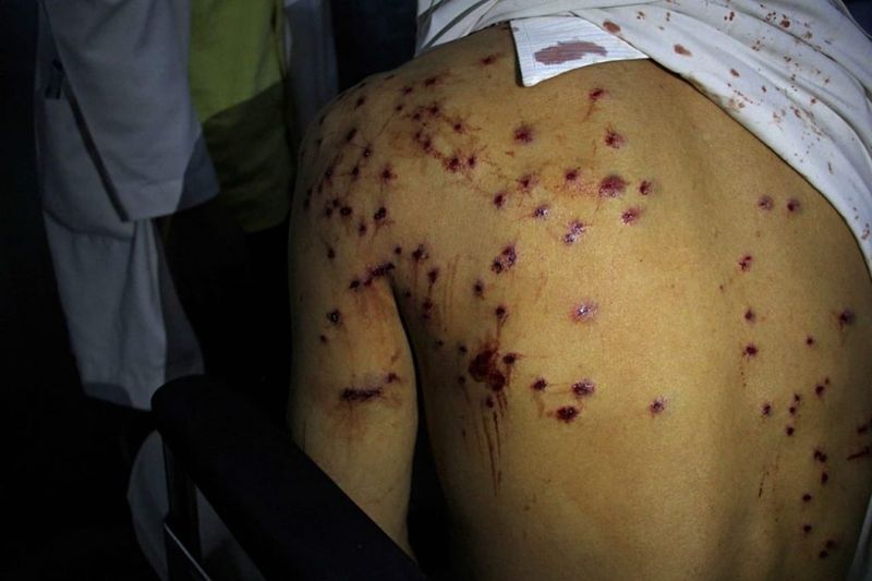 In dismissing pellet injuries as ‘limited damage’, ‘Chauhaan’ loses sight of Kashmir’s grim, brutal reality