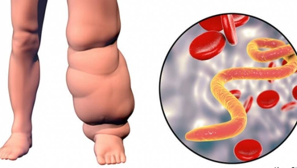 KTFD, Lenfödem Farkındalığı İçin Bilgilendirme Toplantısı Düzenliyor