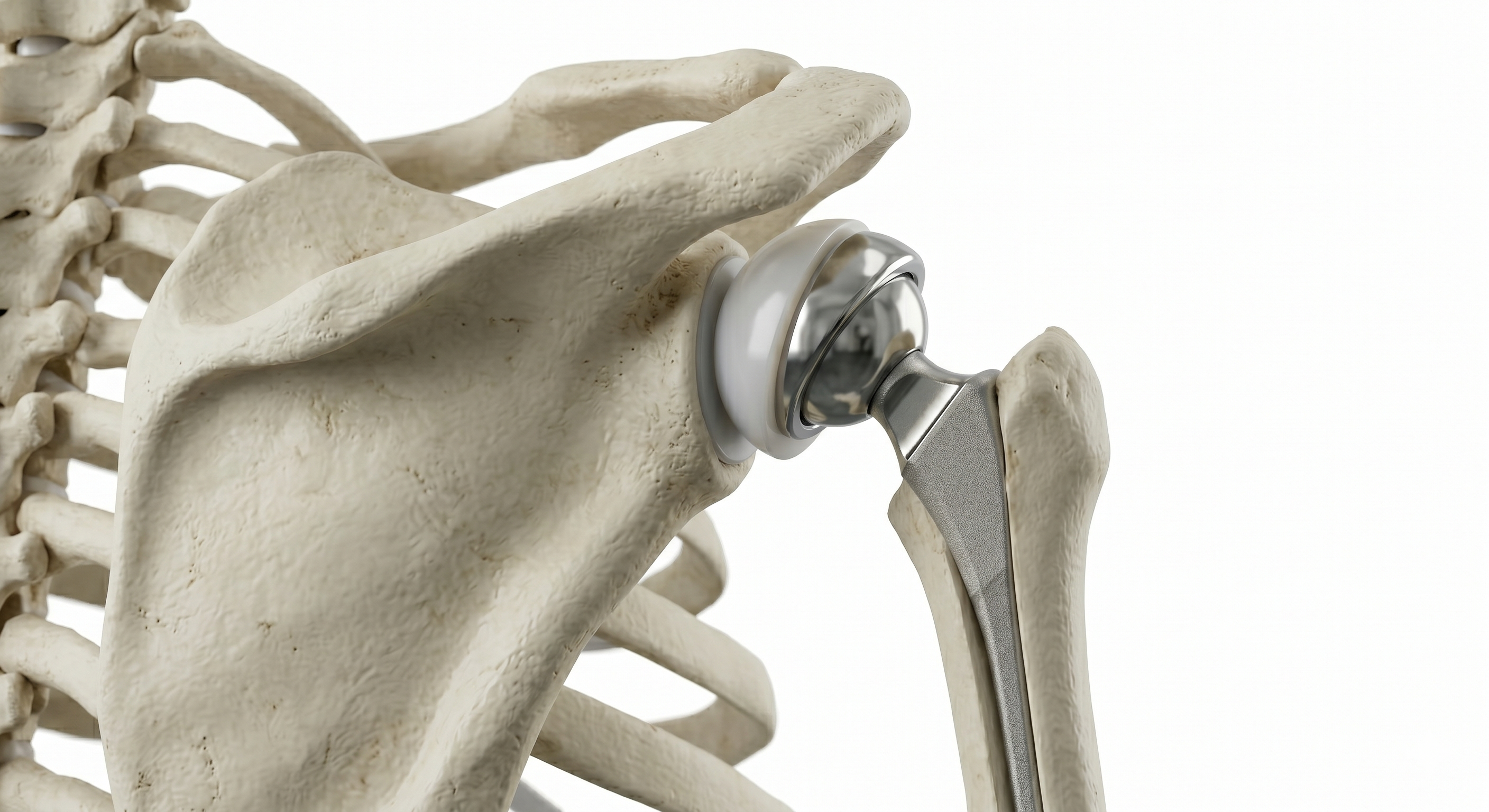 Shoulder Replacement
