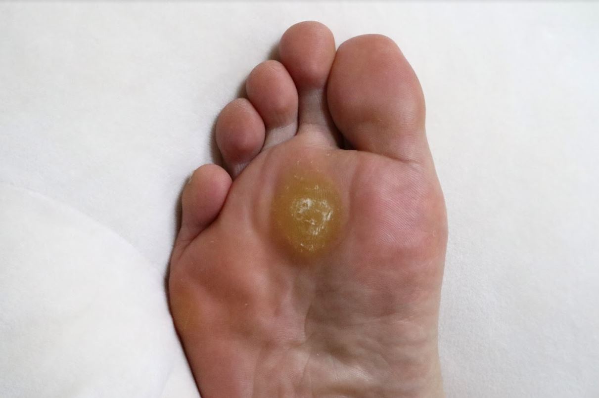 Corn and calluses