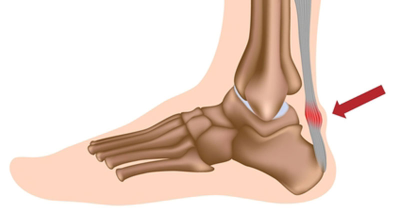 achilles tendinitis