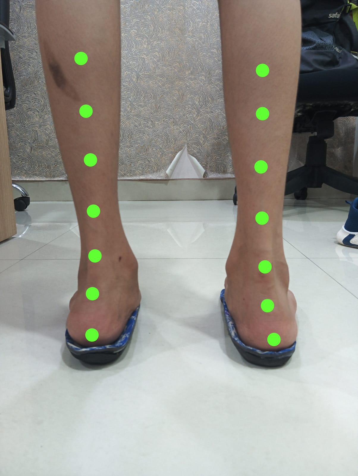 Rear view of both feet with customised insoles, showing improved alignment where the green dots form a straight vertical line, indicating corrected heel and arch posture.