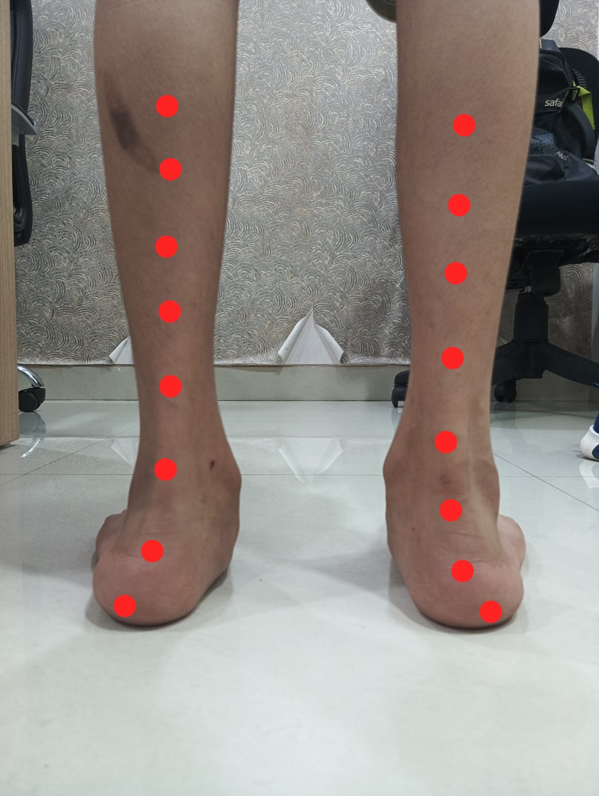 Rear view of both feet showing pes planovalgus deformity with heel valgus and medial arch collapse; red dots indicate outward deviation of the alignment line.