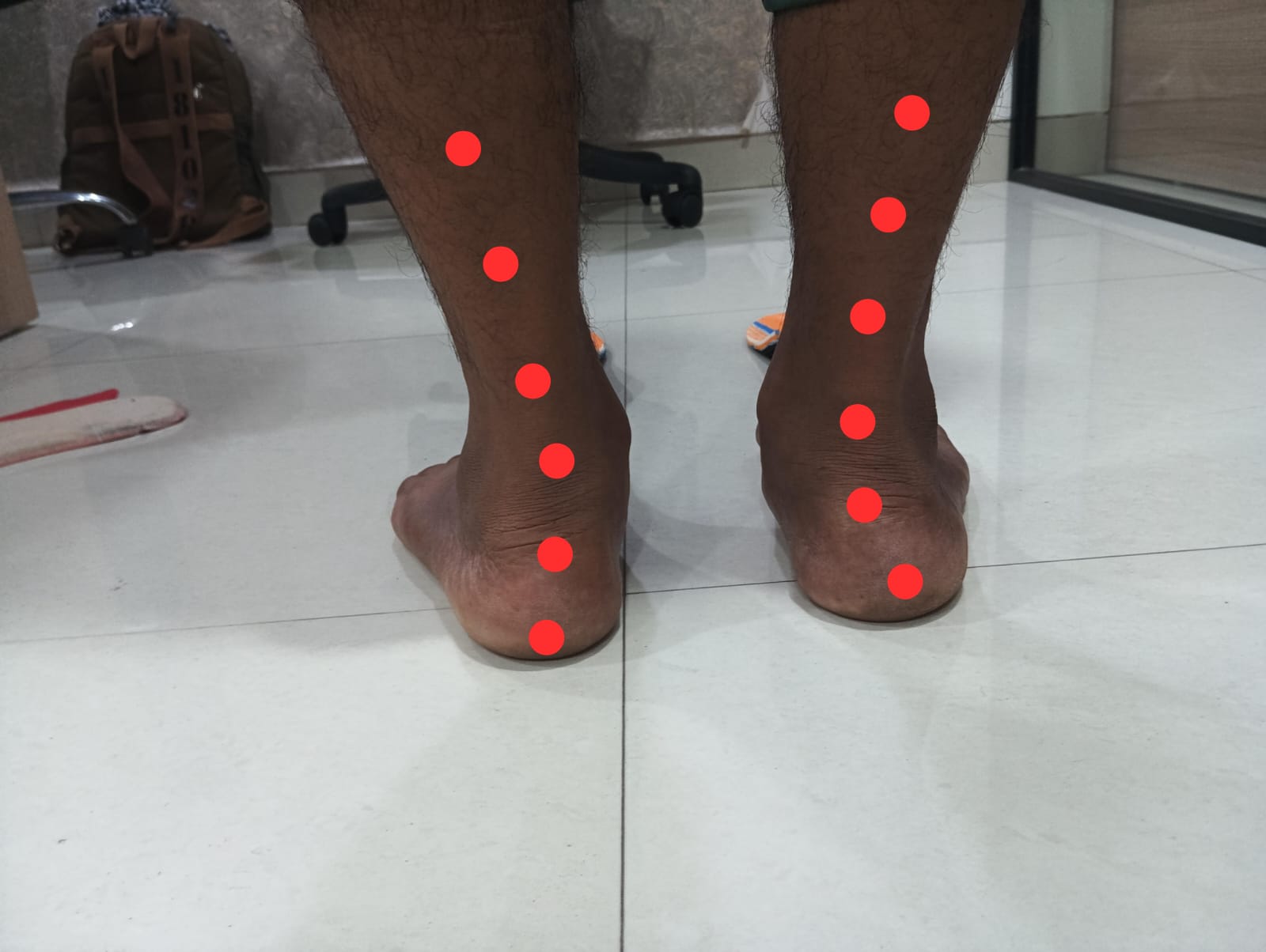 Rear view of both feet showing misalignment due to pes planovalgus deformity. The red dots indicate a lateral deviation of the alignment line, showing heel valgus and collapsed arches.