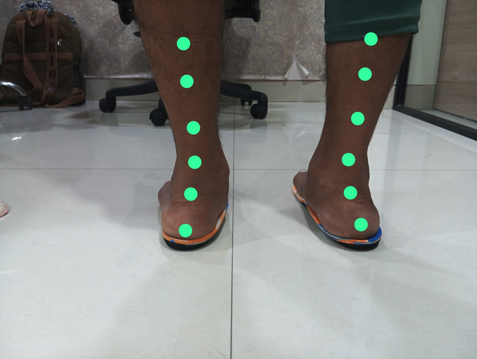 Rear view of both feet with customised insoles in place. The green dots indicate corrected alignment, showing a straight vertical line through the heel and leg, reflecting restored neutral foot posture.