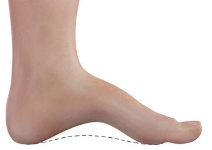 High arches ( pes cavus )