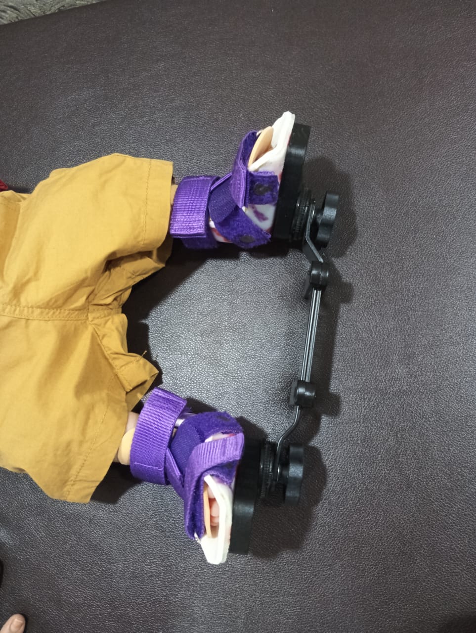 Infant wearing a Dennis Brown Splint with two connected open-toe boots maintaining the feet in corrected abduction and dorsiflexion alignment.
