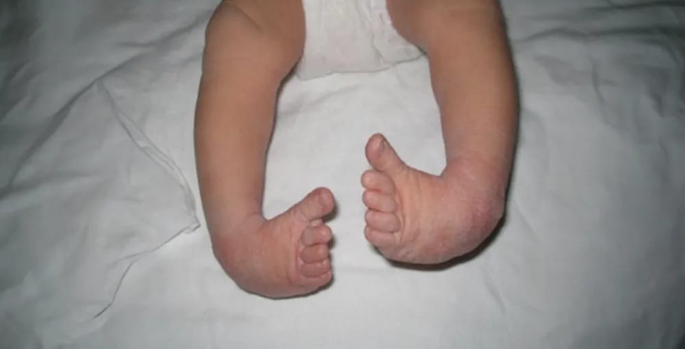Infant with bilateral clubfoot deformity showing inwardly rotated feet and tight soft tissue around the ankle.