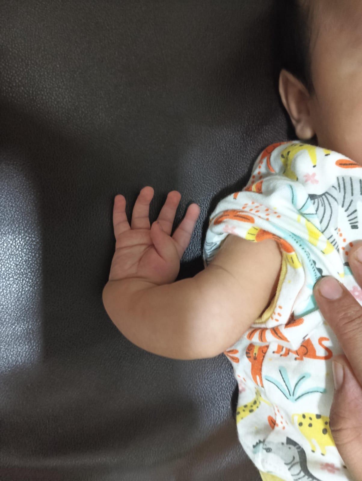 Foot drop condition before AFO treatment