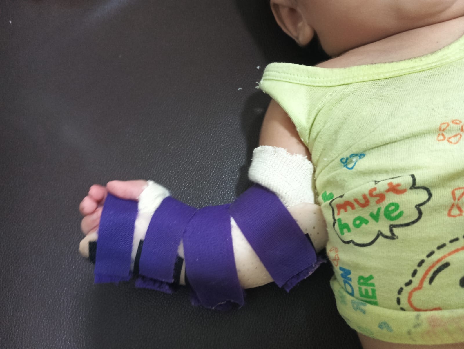 Improved gait and mobility after AFO treatment