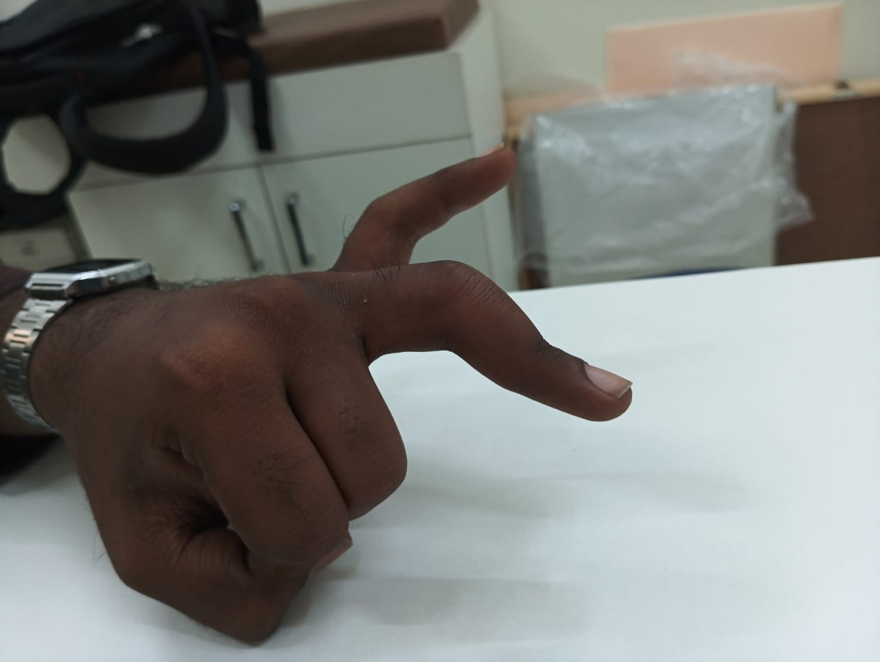 Finger showing Boutonnière deformity with flexion at the PIP joint and hyperextension at the DIP joint.