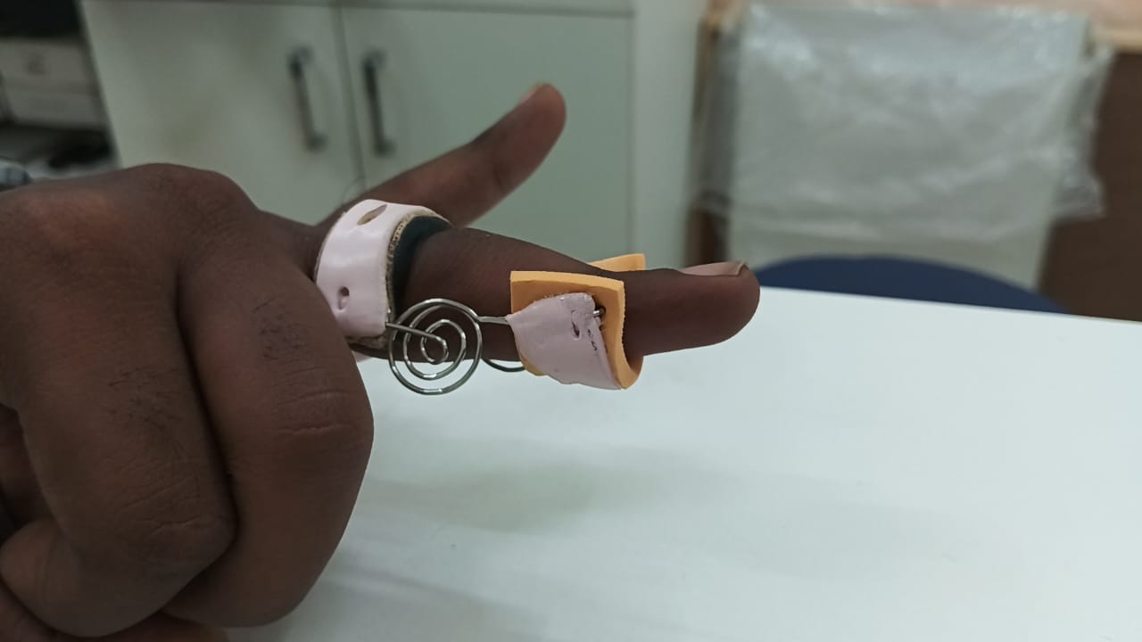 Finger fitted with a Capener splint providing dynamic extension at the PIP joint, demonstrating corrected alignment and improved posture.