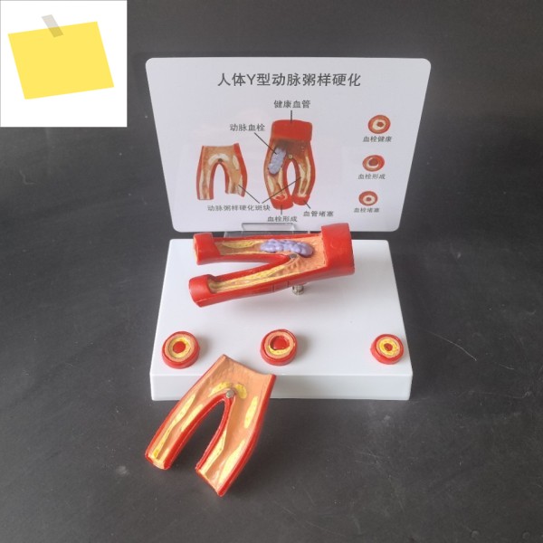 심혈관 및 폐색 모델, 지방 병리학적 죽상동맥경화증, 인간 해부 제품 이미지