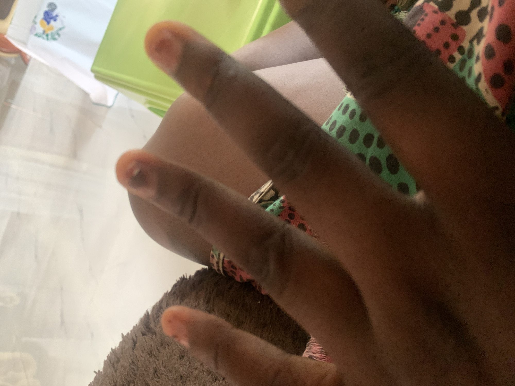 The image shows a close-up of a person's hand, with fingers prominently displayed. The skin tone is dark. Several fingernails are visible, some with what appears to be a reddish or orangish tint. One fingernail, on what seems to be the index finger, has a small dark mark near the tip. The person is wearing patterned clothing, featuring green, pink, and black spots. In the background, a textured brown surface (possibly a rug) is visible on the left. Further back, a bright green object, possibly a chair or container, and a white cloth with colorful embroidered elements are present. The overall setting suggests an indoor environment. The image does not provide any specific information about the location in Jauro Yinu, Nigeria.