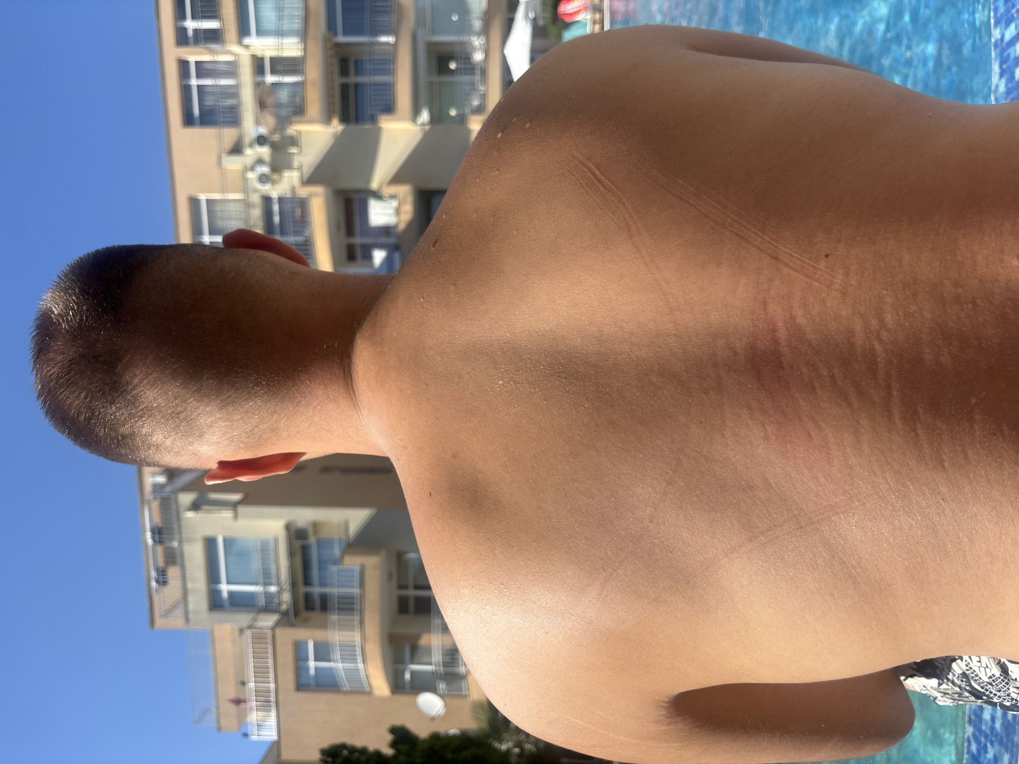 The image depicts the back of a person, seen from behind, with distinct red marks resembling lines or stripes on the skin. The person is shirtless and appears to be in an outdoor setting, likely a resort or hotel with a swimming pool visible in the foreground. In the background, a multi-story building with balconies and windows is visible. The sky is clear and blue. The environment suggests a sunny day, consistent with a vacation or leisure activity. The presence of the building and the swimming pool indicate an urban or developed recreational area, potentially a tourist destination. Based on the context provided, the location is identified as Nesebar, Bulgaria.