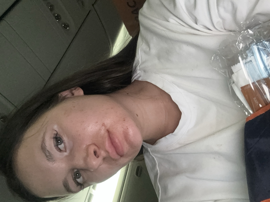 The image is a close-up, rotated portrait of a young adult female taken indoors, likely in a mode of transport such as an airplane or car. She has long, dark hair and fair skin with visible freckles. Her eyes are open and looking towards the camera. The most prominent feature is a significant swelling on the lower left side of her face, which affects her left cheek, upper lip, and lower lip, causing a visibly puffy and distorted appearance. The skin in the swollen area appears somewhat red or irritated. She is wearing a plain white t-shirt.
In the background, overhead paneling with what appears to be circular fixtures (possibly air vents or lights) is visible, consistent with a vehicle interior. To her right, a clear plastic package containing several small, individual packets is partially visible. On one of these packets, the word "salt" can be clearly read. A dark blue or black object, possibly a blanket or bag, is next to the plastic package. The image appears to be a personal snapshot, possibly a selfie, focusing on the individual and her facial condition within a travel setting.