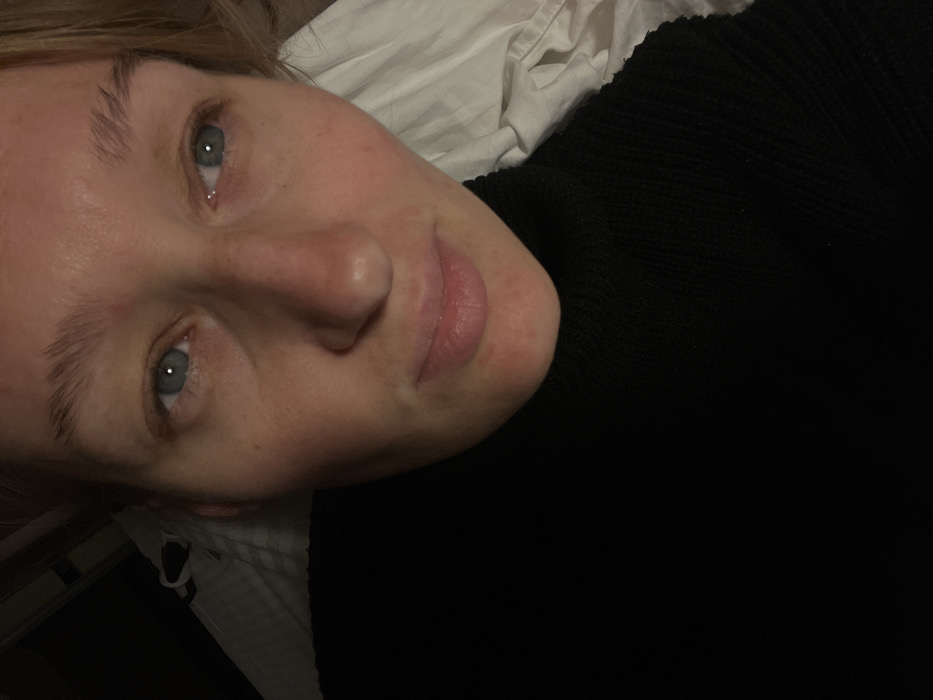 A close-up indoor photograph depicts an adult female subject. She possesses light skin, light blue eyes, and light-colored eyebrows. Visible facial features include freckles across the nose and cheeks, and multiple small, red circular blemishes primarily concentrated on the chin and surrounding the mouth. The subject is wearing a black, high-necked, ribbed garment, indicative of a sweater or turtleneck. Her gaze is directed slightly upwards and to the left of the frame. The subject appears to be in a reclined or lying position. To the right of the subject, a crumpled white fabric, consistent with bedding or a pillow, is visible. The left and upper background areas are dark and indistinct. The lighting is low and ambient. The location is identified as Budva, Montenegro.